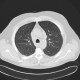 Welder's lung, pulmonary siderosis: CT - Computed tomography